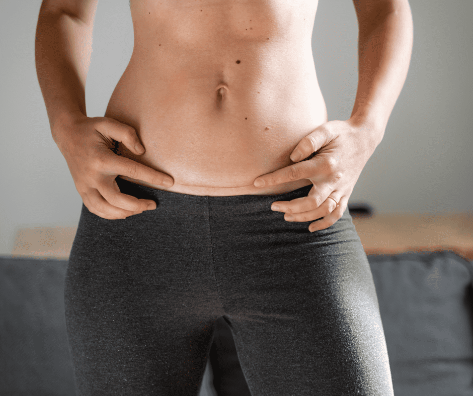 A bare-bellied woman points towards the lateral scar on her abdomen left from a hysterectomy